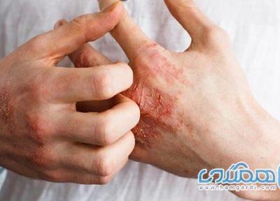 برای برطرف خارش پوست دست از چه کرمی استفاده کنیم؟